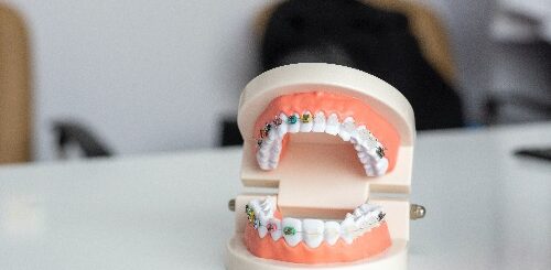 tandretning af skæve tænder